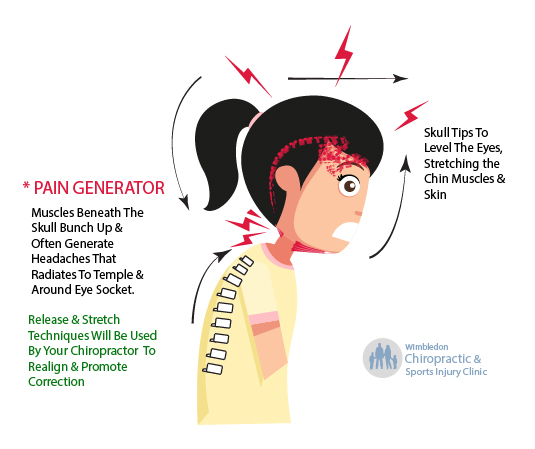 Covid 19 Headaches The Work From Home Syndrome