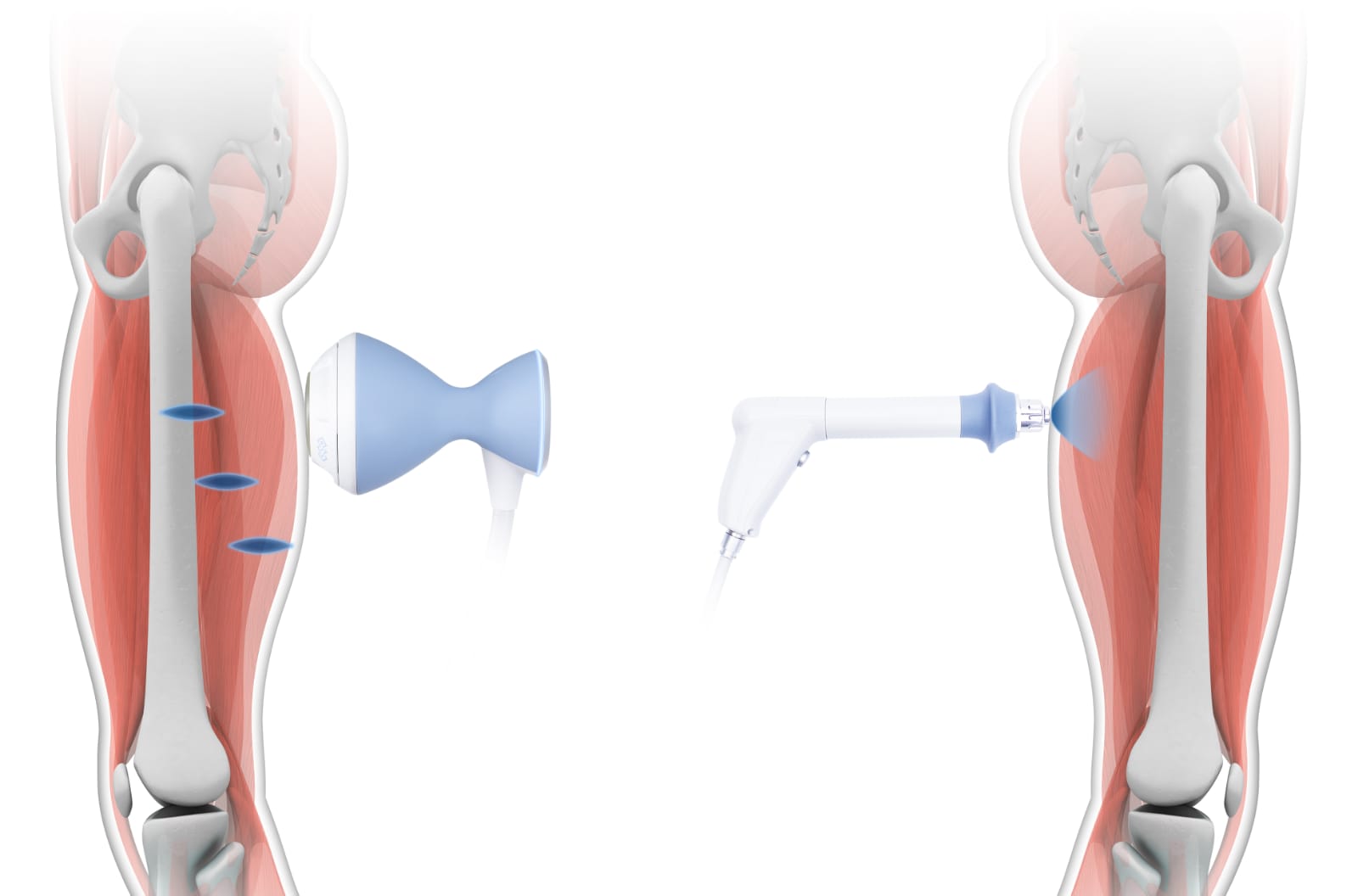 focused vs radial extracoropeal shock wave therapy and depth penetration Wimbledon Chiropractic Sports Injury Clinic
